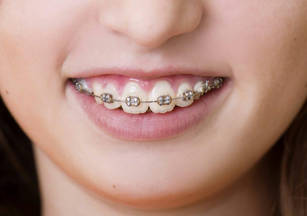 Orthodontie pour enfants et adultes : Remboursements et solutions