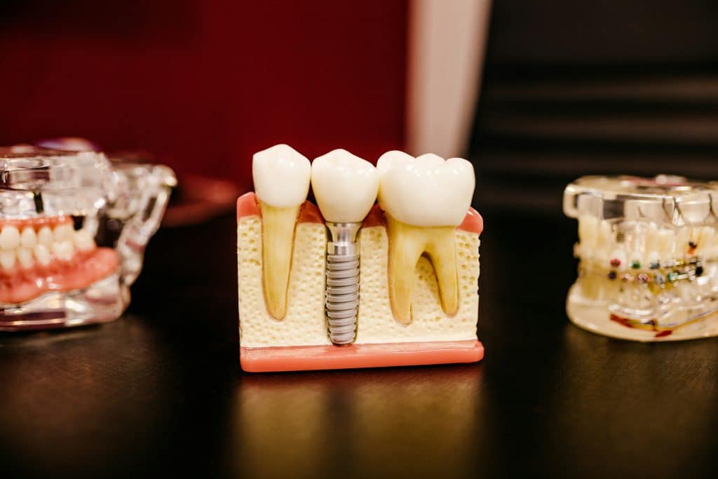 Qu’est-ce qu’un implant dentaire ? Indications, avantages et alternatives