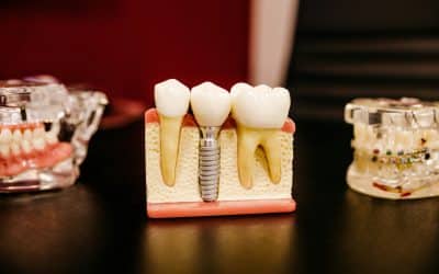 Qu’est-ce qu’un implant dentaire ? Indications, avantages et alternatives